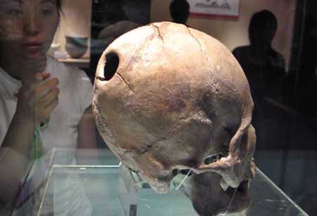 山东省博物馆展出5000年前开颅手术实例颅骨