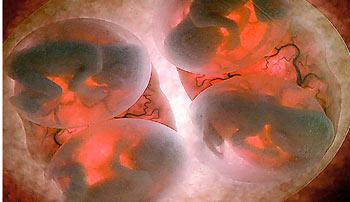 科学家拍到子宫中胎儿照片:四胞胎争夺地盘