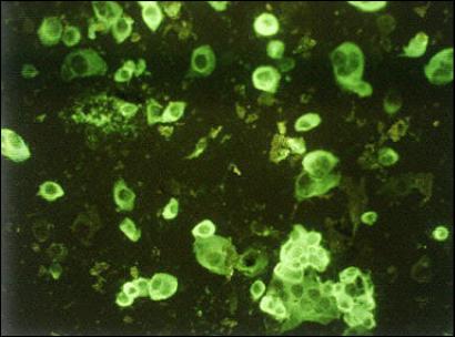 图文:显微镜下被SARS病毒感染的人体细胞