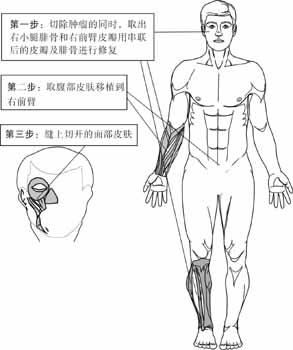 取下腿骨臂肉重塑半边脸 组图