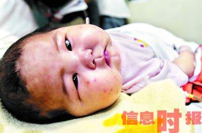 广州大头娃出生5个月脸肿透明 疑吃奶粉所致