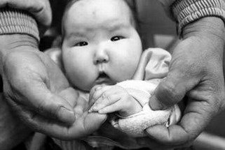 江西南昌又现劣质奶粉受害婴儿呈现大头婴症状