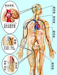 然后形成栓塞