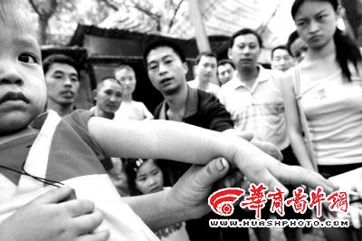 娃娃幼儿园摔断臂 接骨竟接歪(图)