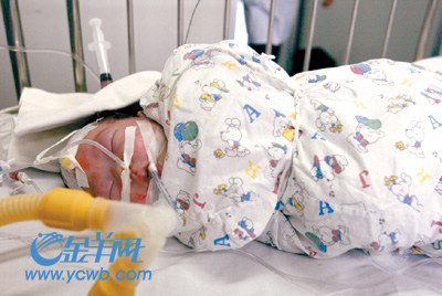 上海复旦大学附属儿科医院成功分离连体女婴