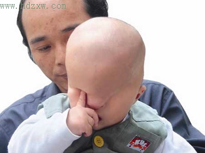 1岁男孩天生没眼厦门医生为他"开眼"