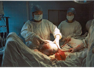 医疗组对患者实施剖腹探查术+全子宫双附件切