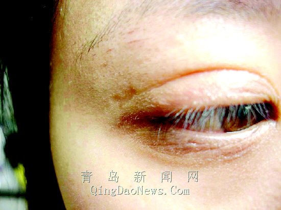 割完双眼皮留疤痕 24岁女子做完手术怕见人(图