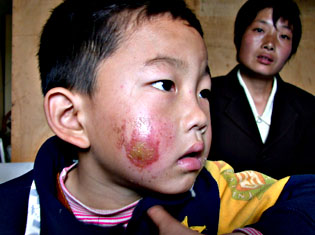 6岁孩子遭家长报复 打火机残忍烧伤孩童双颊(