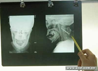 老妇摔伤颈椎骨骼松动 手术植入螺钉固定(附图
