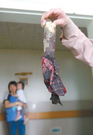 男子肺部被粗树枝戳出两条10厘米多长裂缝(图
