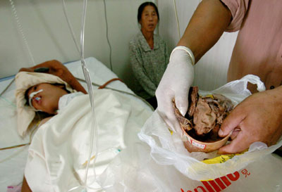 女子在卫生院剖腹产手术纱布留子宫一年图