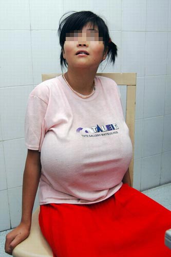 12岁女孩双乳大如足球欲做乳房缩小术(图)