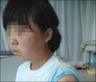 残疾女生遭到女同学围殴 被迫用卫生巾止血(图