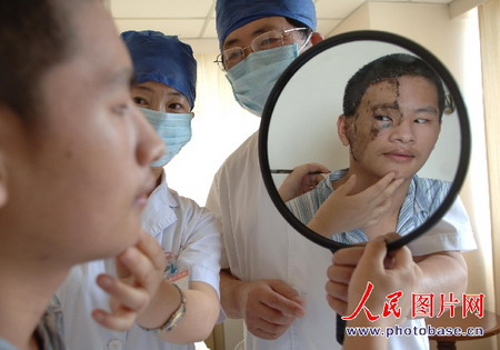 男子脸上长黑毛上海成功实施换脸手术(组图)