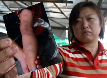 老师就用小手指般粗细的竹条子打紫了他的双腿,孩子的腿受伤了,心上的