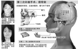 女孩患罕见脸萎缩症将再次取头骨补脸(图)