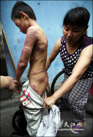 男孩遭父毒打报警 满身伤痕触目惊心(图)