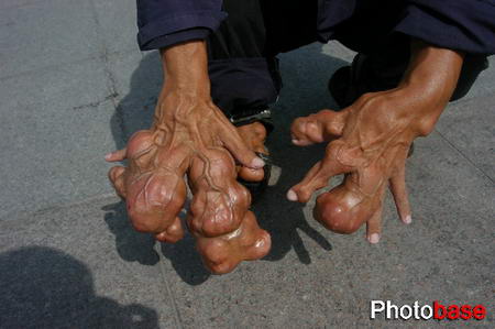 42岁男子手指变形 长得像蘑菇(胆小勿进!