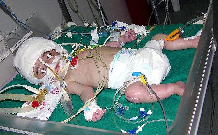 组图：埃及双头女婴手术一年多后死亡