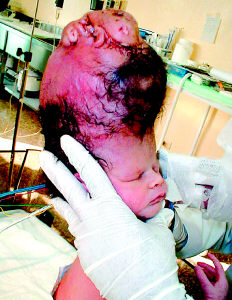 埃及女婴头部寄生胎图片