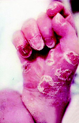 儿童梅毒早期症状图片图片