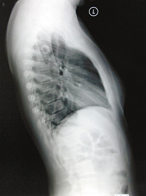 肺结核患者胸透片,可清楚看到肺部的空洞