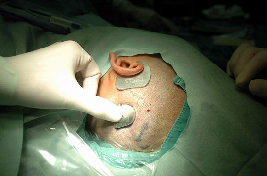人工耳蜗植入体图片