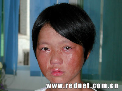 山东16岁女孩烧伤图片