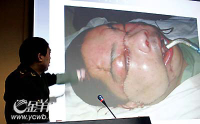 韩岩:患者李国兴目前身体状况,精神状况都不错,面部缝合部分已经拆线