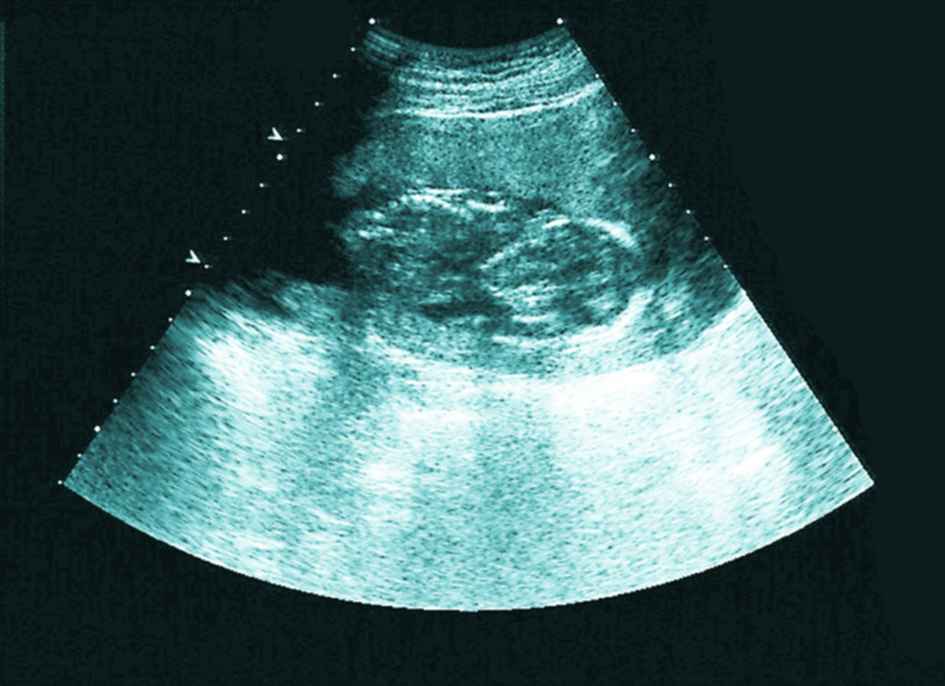 怀孕两个月b超图片图片