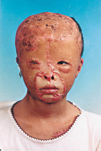 被硫酸毁容的脸图片图片