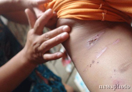 组图:8岁女孩被父亲女友用烧红剪刀刺伤