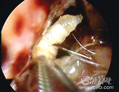 老汉鼻内爬百余蝇虫长期鼻窦炎吸引苍蝇产卵