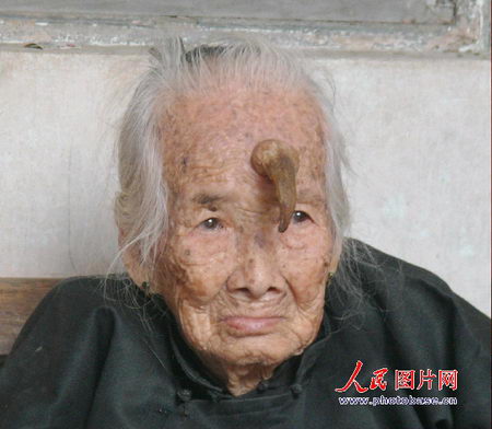 广东95岁老太额头长出12厘米犄角(组图)