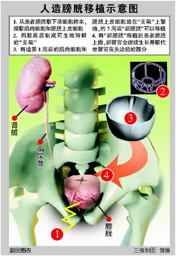 人造膀胱在美實現成功移植